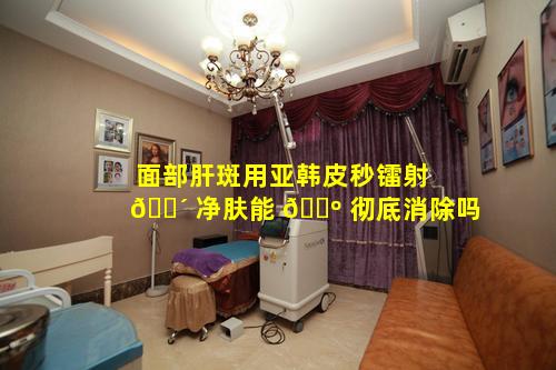 面部肝斑用亚韩皮秒镭射 🐴 净肤能 🐺 彻底消除吗